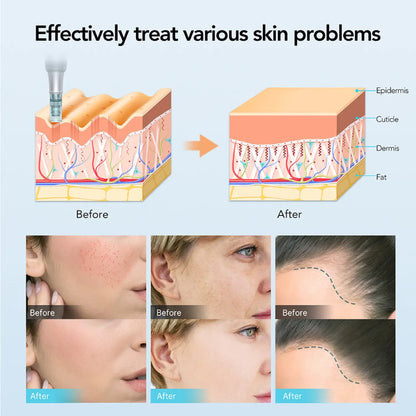 Dr. Pen M7S Microneedling Pen